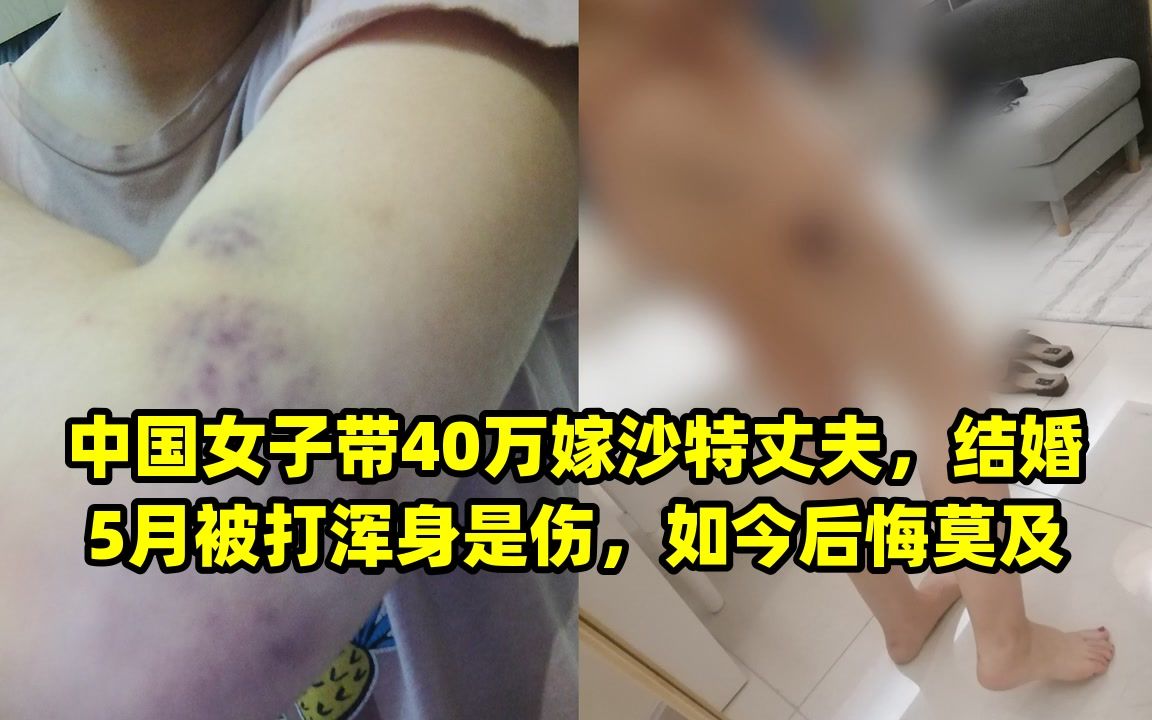 中国女子带40万嫁沙特丈夫,结婚5月被打浑身是伤,如今后悔莫及哔哩哔哩bilibili