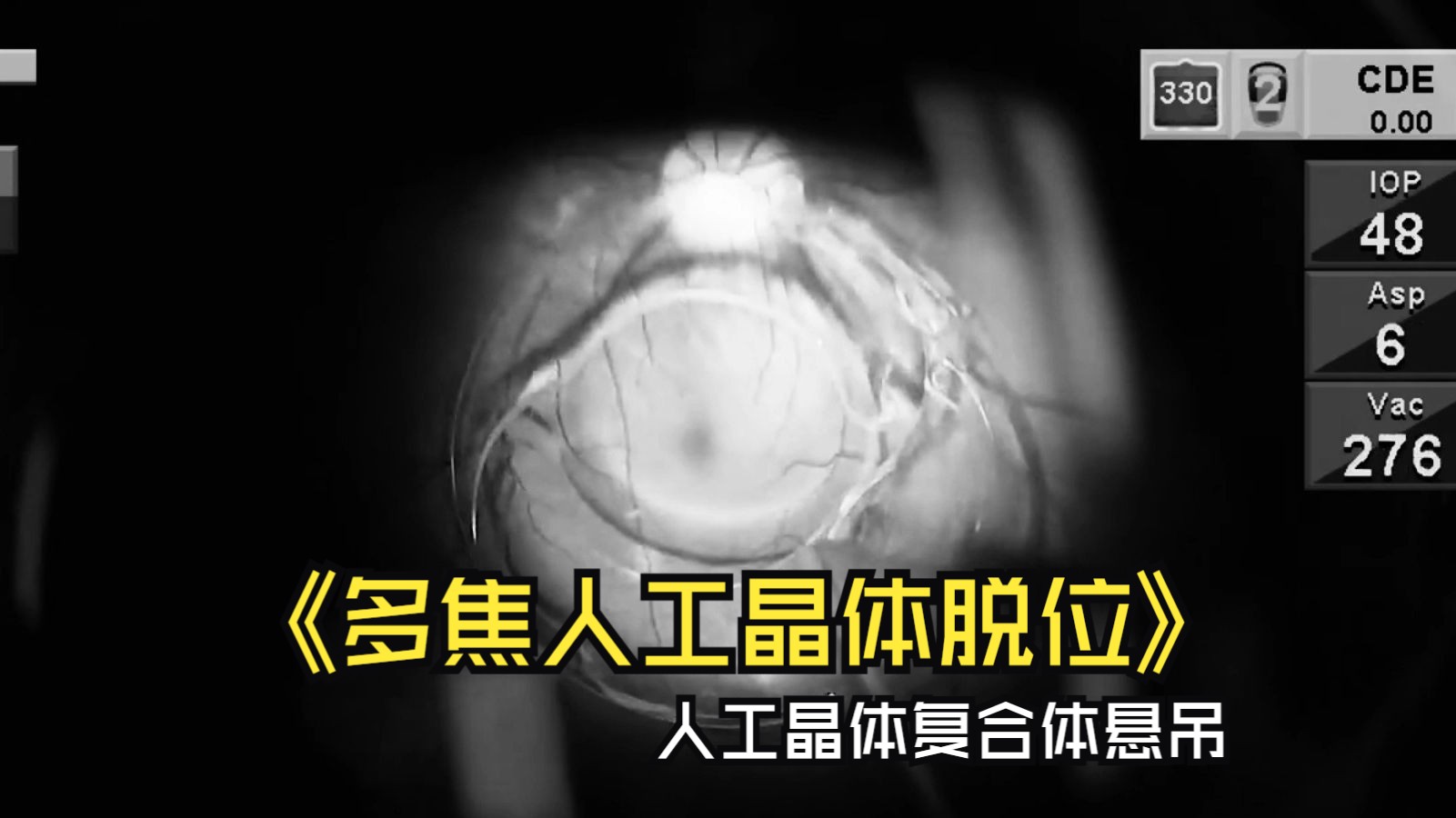 【多焦点人工晶体脱位】dislocated multifocal lens implant on the
