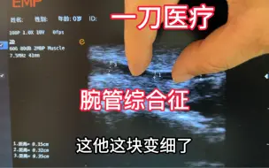 Download Video: 超声定位下腕横韧带切开术治疗腕管综合征手指麻木