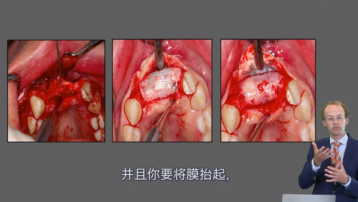 用rhBMP2 自体骨,异体骨和钛网做下后牙垂直骨增量——g种植(共50节)哔哩哔哩bilibili