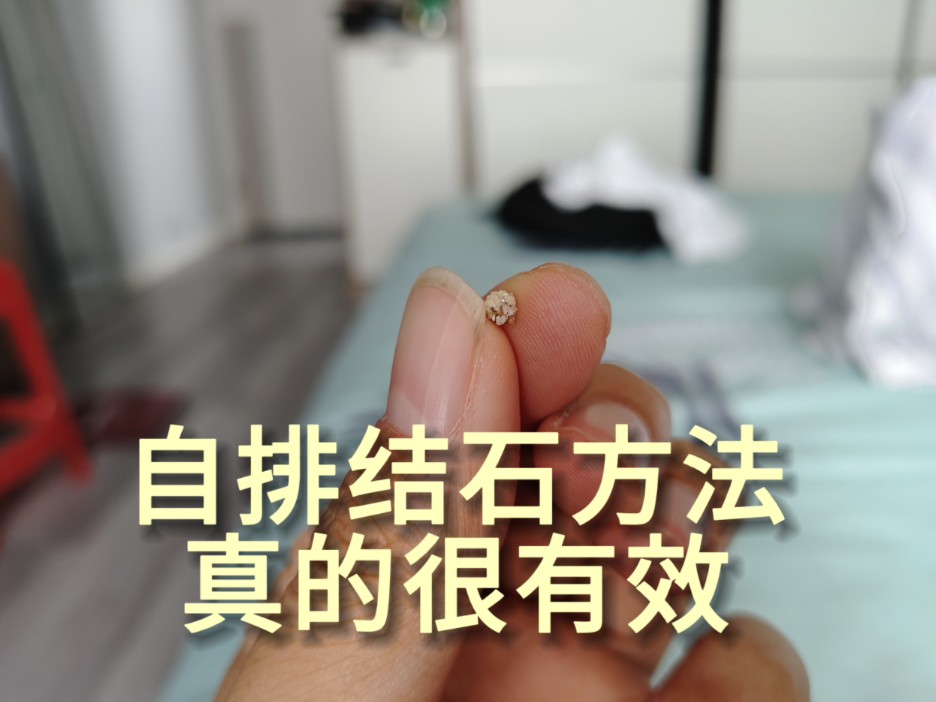 肾结石最快的排出方法图片