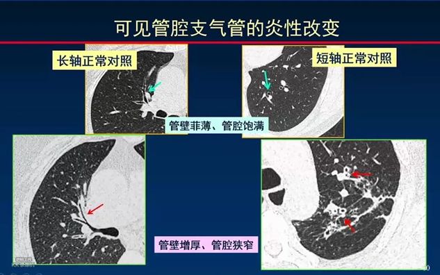 [图]6.HRCT对肺结核细节的观察-胸部影像诊断思维训练营系列4