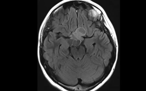 【视神经胶质瘤影像】Optic Nerve Glioma T2 FLAIR哔哩哔哩bilibili