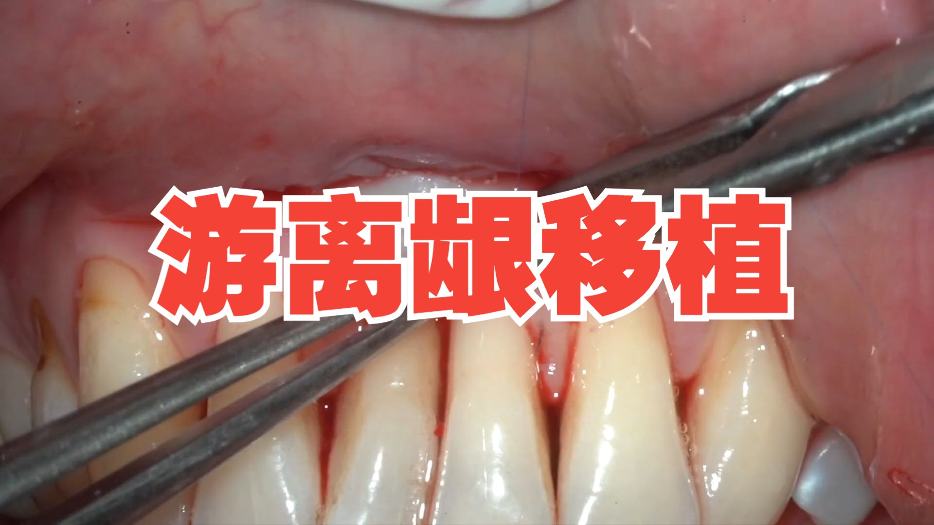 游离龈移植:free gingival graft and frenotomy