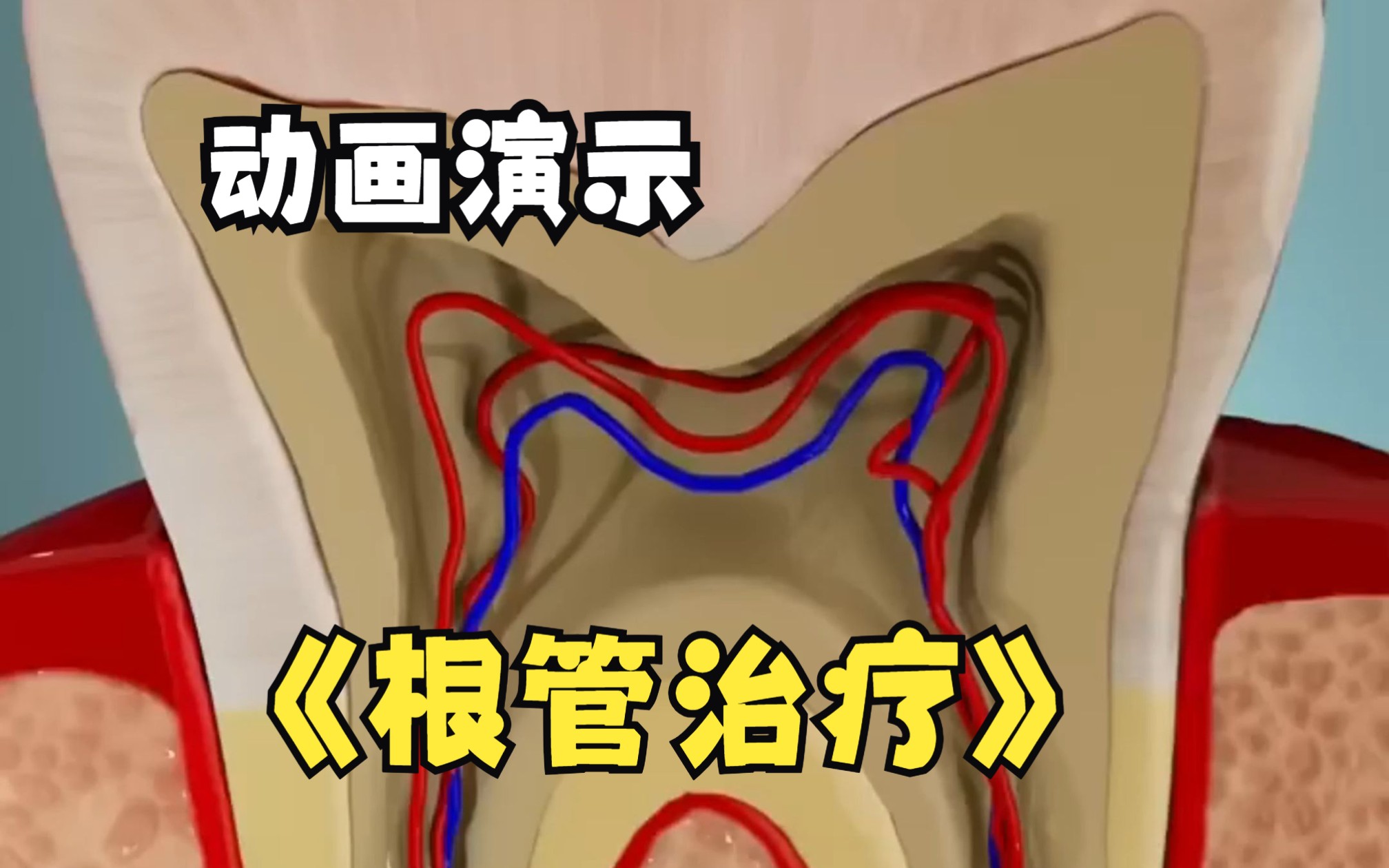 根管治疗过程动画详示,还不清楚根管治疗是怎样做的,赶紧来看看吧!哔哩哔哩bilibili