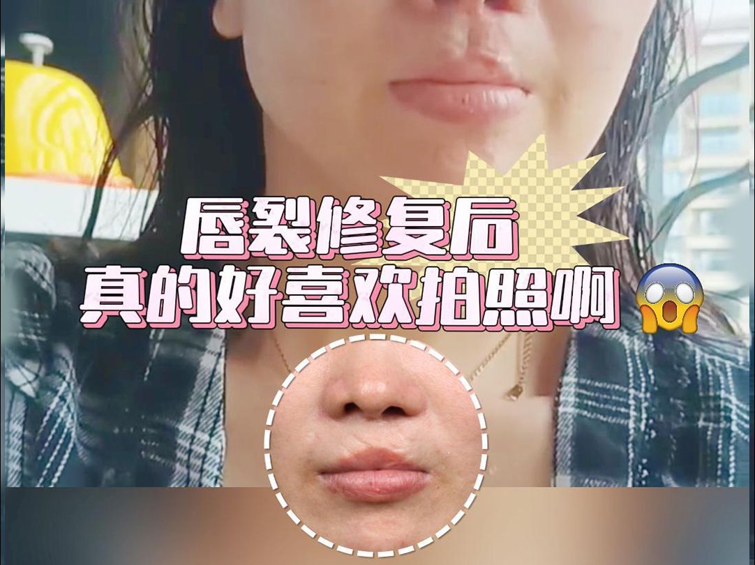 唇裂修复后真的好喜欢拍照!