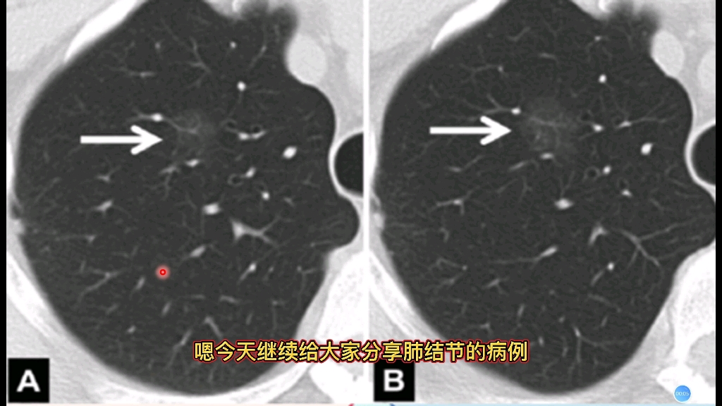 中年女性,CT体检发现肺部纯磨玻璃结节,最后诊断什么?哔哩哔哩bilibili