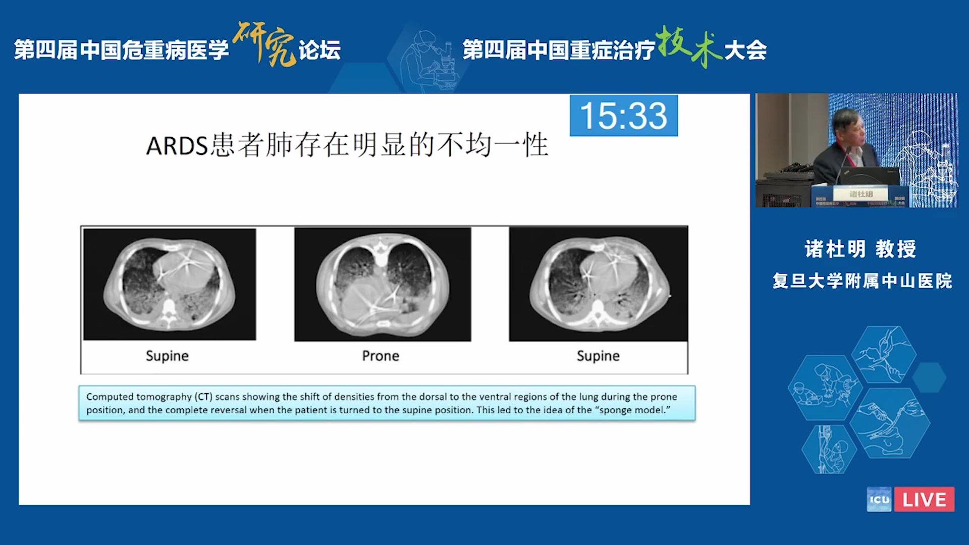 俯卧位通气 诸杜明:复旦大学附属中山医院哔哩哔哩bilibili