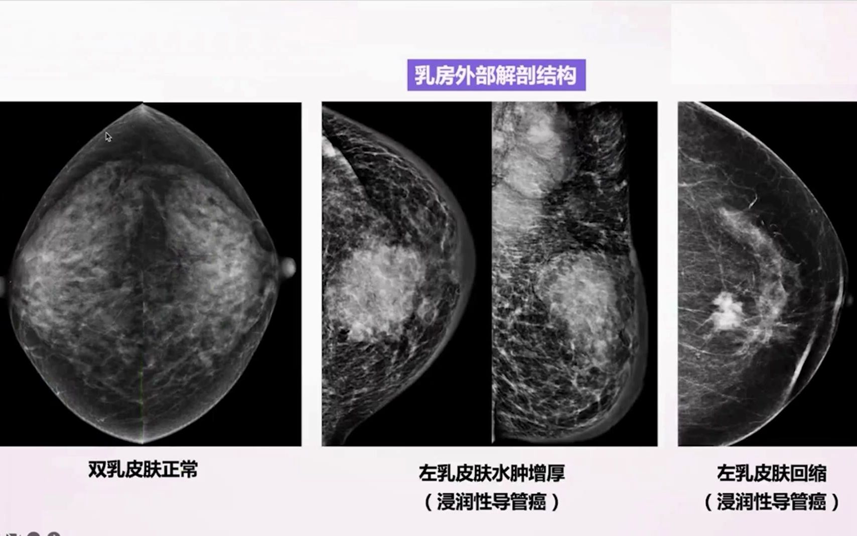 4.乳腺X线影像解剖及象限定位乳腺X线诊断培训系列1哔哩哔哩bilibili