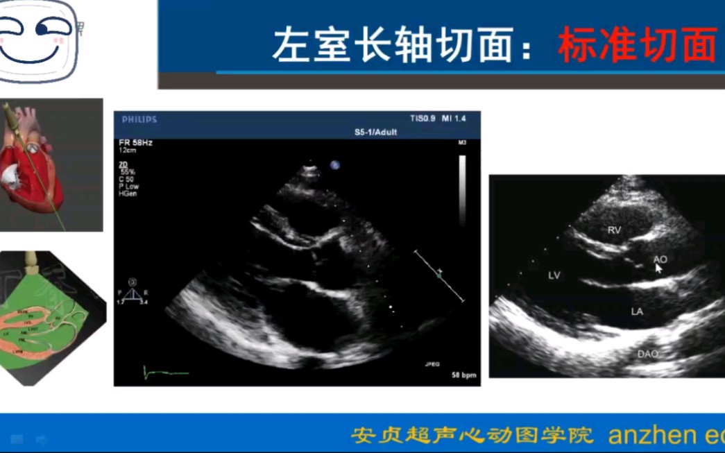 [图]心脏超声切面01:胸骨旁长轴观（杨老师心脏切面课程全套15集，很细致的讲透心超基础入门）