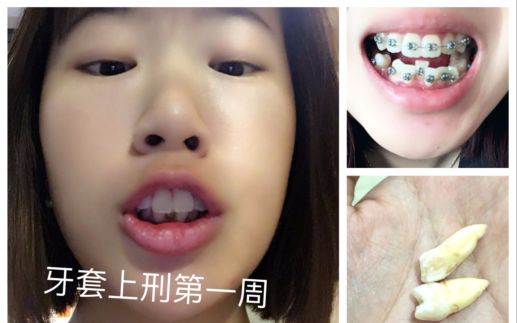 龅牙妹要蜕变!(牙套上刑第一周初体验)_哔哩哔哩_bilibili