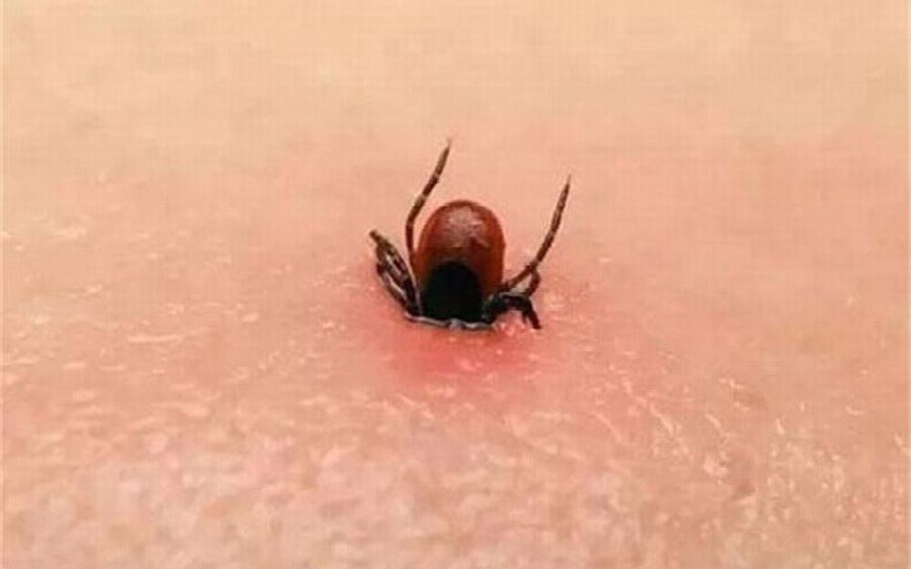 被蜱虫咬伤的伤口是怎样的?咬伤后该怎么处理?