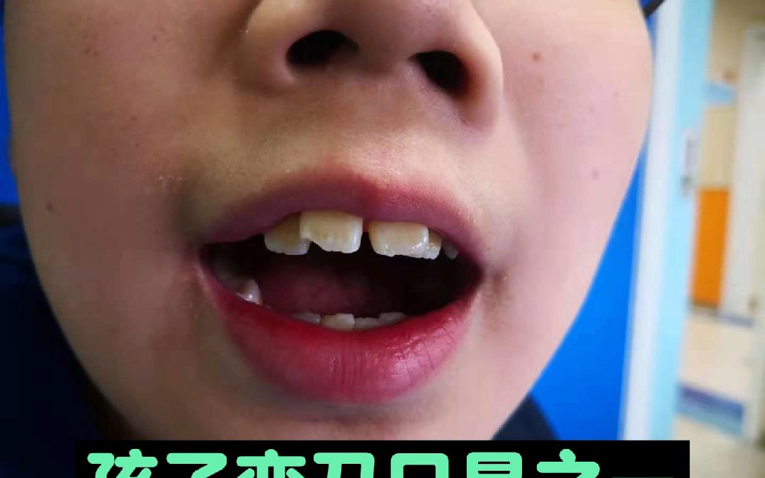 腺样体面容张口呼吸,打呼噜,孩子变丑只是之一,危机超出家长想象