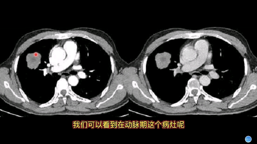 [图]肺部典型病例分享：肺黏液腺癌在CT上什么表现？医生讲解