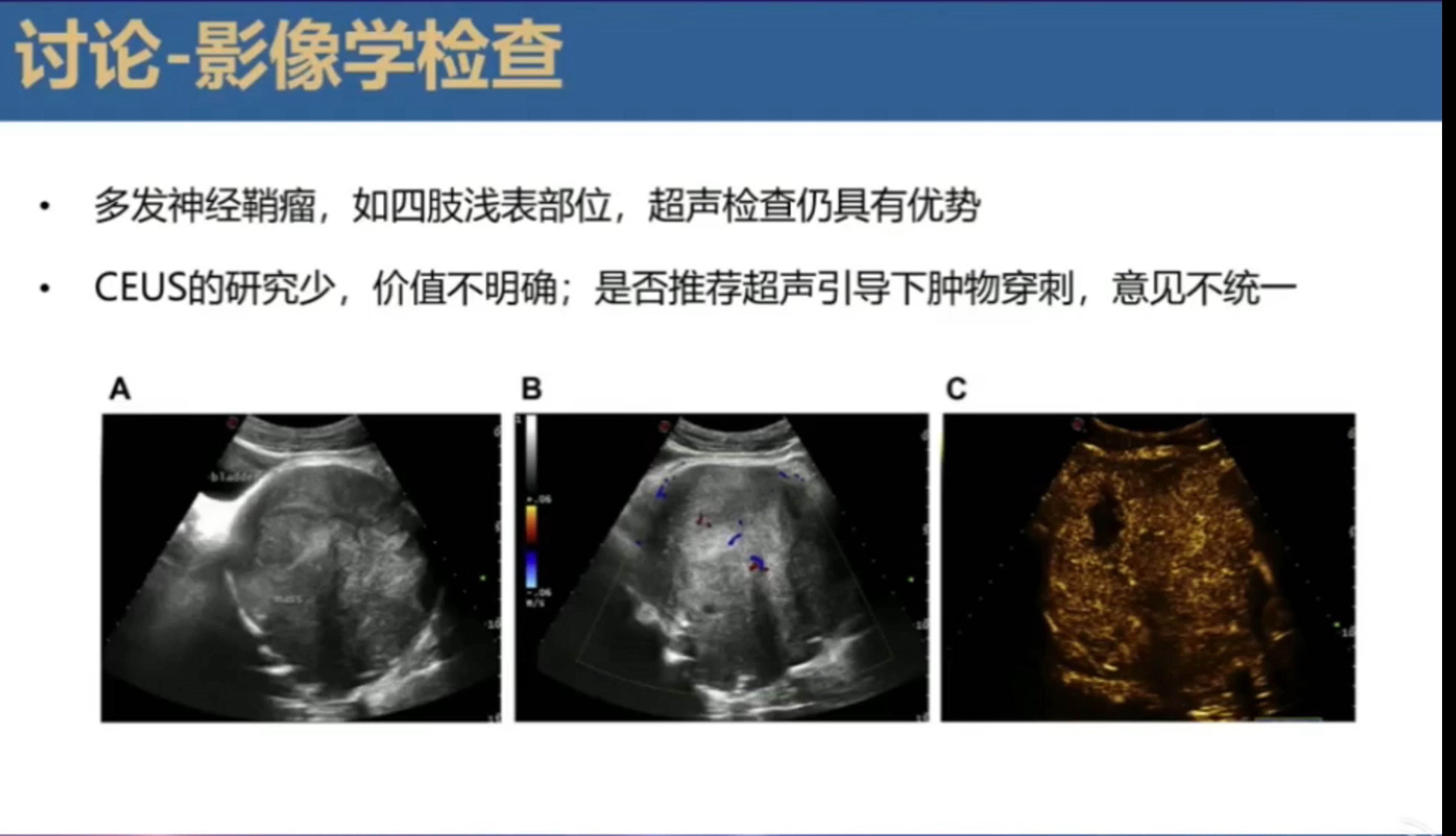 【腹部超声】神经鞘瘤的超声诊断