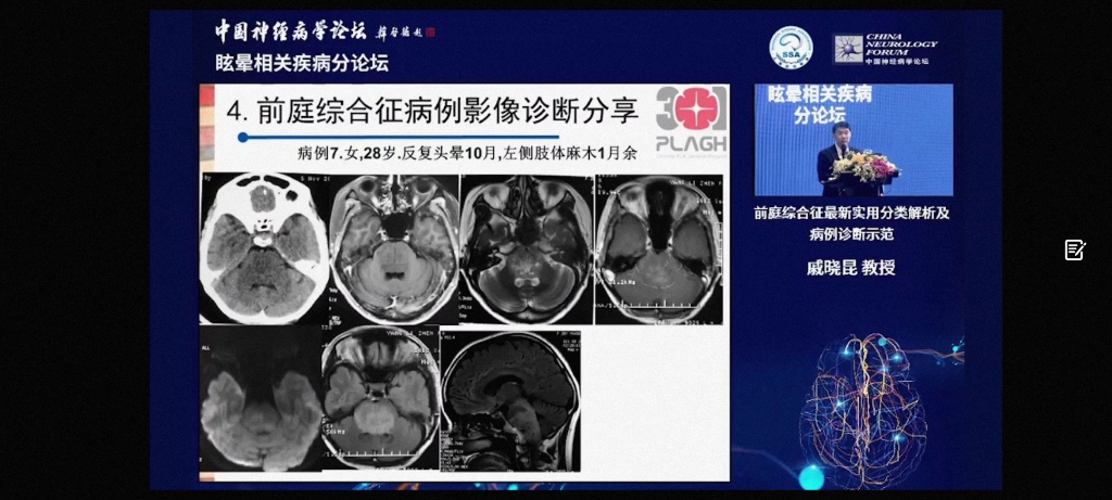 前庭综合征最实用分类及解析(戚晓昆)哔哩哔哩bilibili