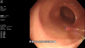 从肛门进入的结肠镜检查过程，便秘原因，3D演示。。