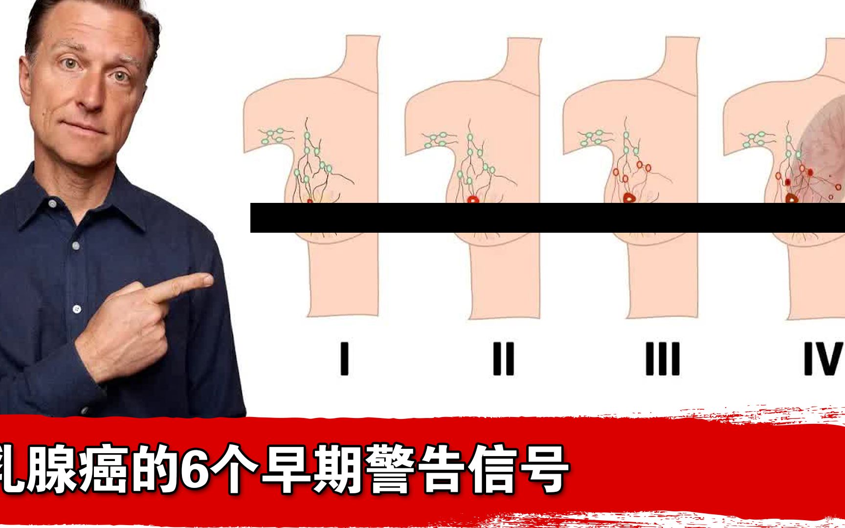 乳腺癌的6个早期警告信号是什么?哔哩哔哩bilibili