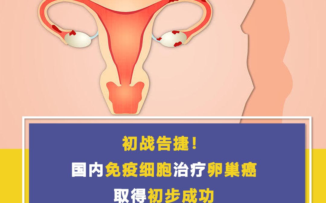 初战告捷! 国内免疫细胞治疗卵巢癌取得初步成功哔哩哔哩bilibili