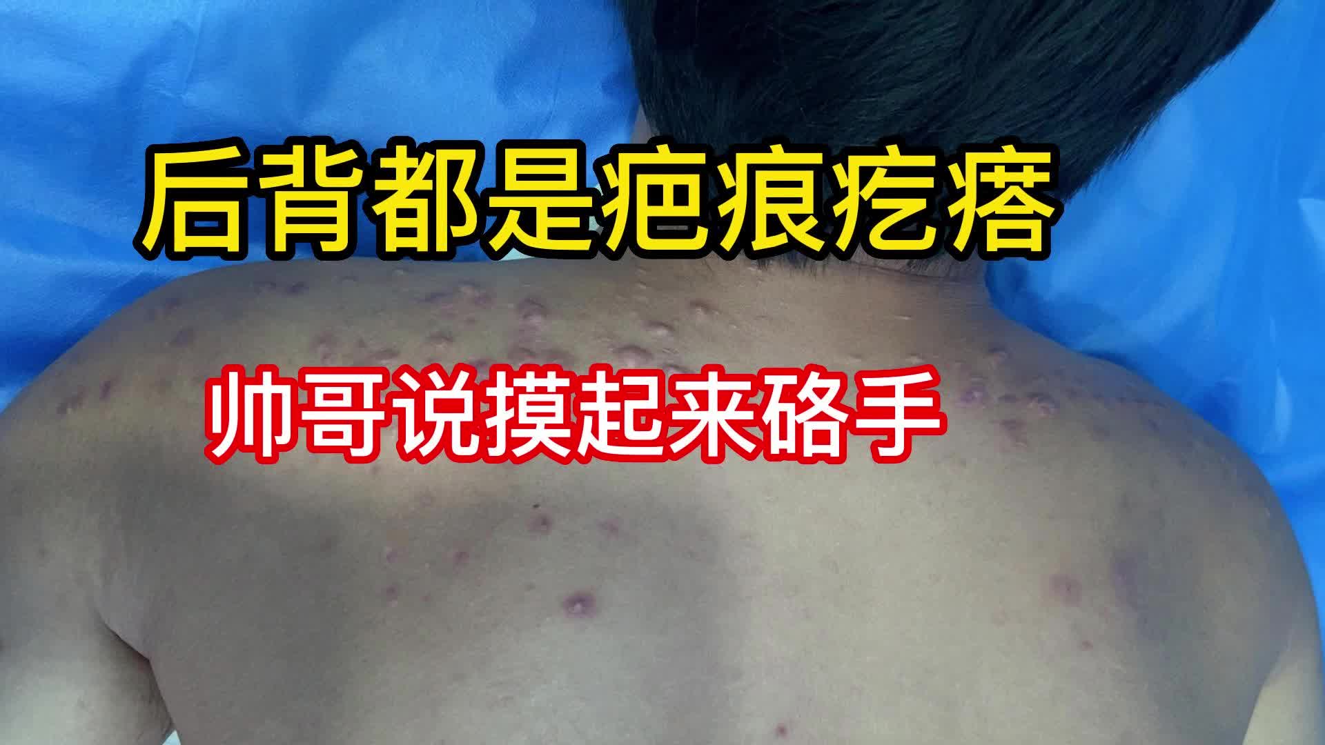 毛囊炎导致的一大片疤痕疙瘩,帅哥说摸起来硌手