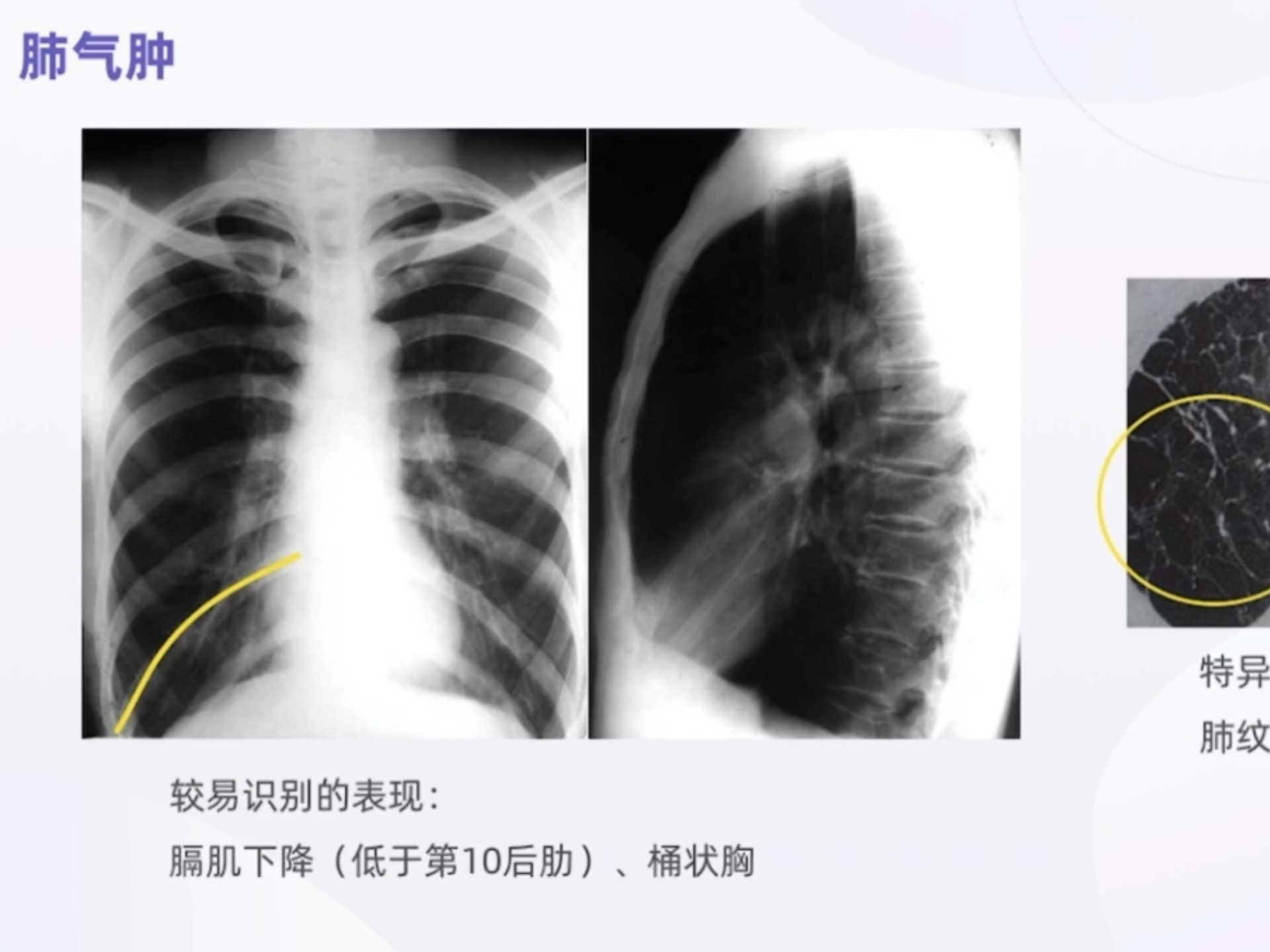 手把手教你读懂胸部x线