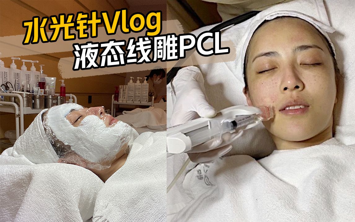 [医美]水光针VLOG前后10天对比/恢复后效果分享/三次PCL水光=埋线?哔哩哔哩bilibili