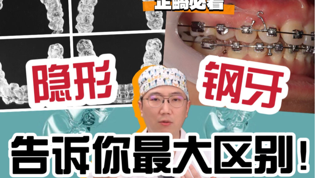 隐形牙套与钢牙目前发现来最大的区别?哔哩哔哩bilibili