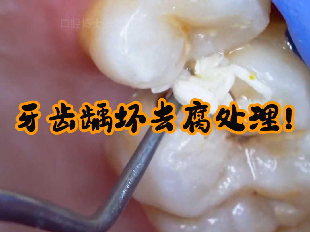你以为蛀牙没多大事?看看这个龋洞你知道严重性啦!