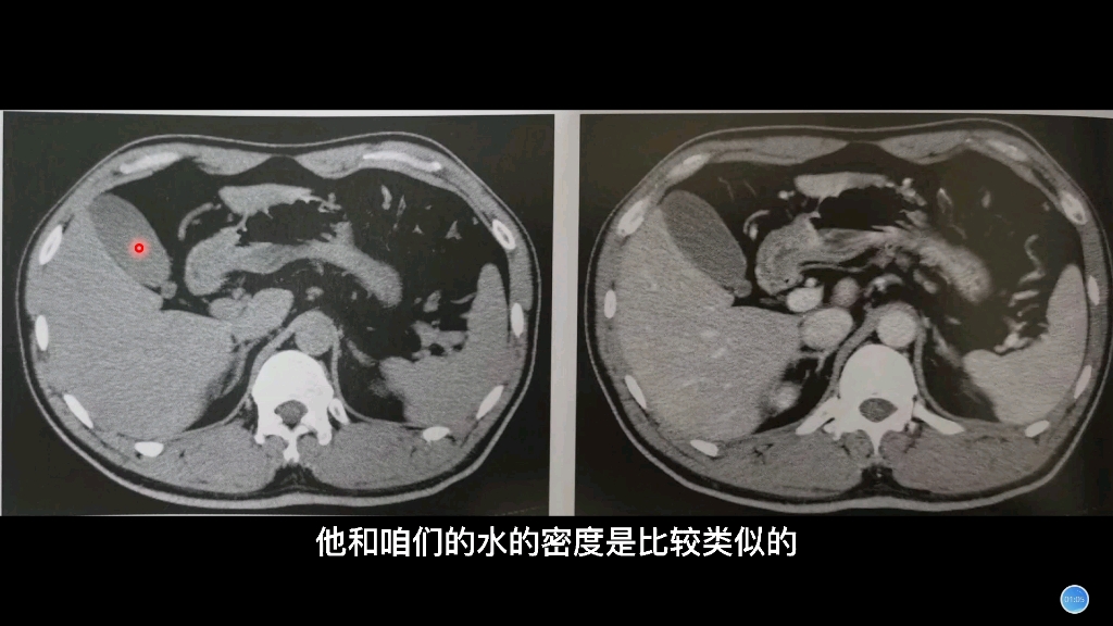 影像解剖讲解:正常胆囊、胰腺在CT上什么表现?放射科医生分享哔哩哔哩bilibili