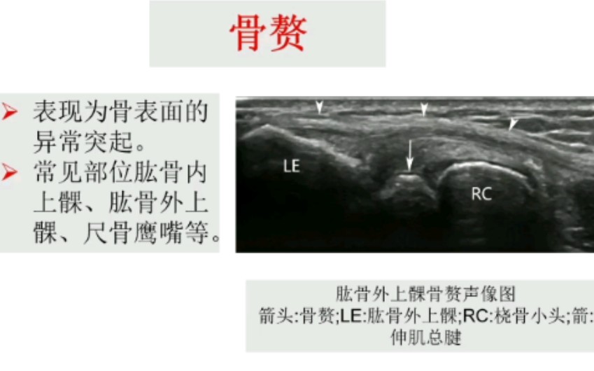 【肌骨超声】骨、软骨及关节病变哔哩哔哩bilibili