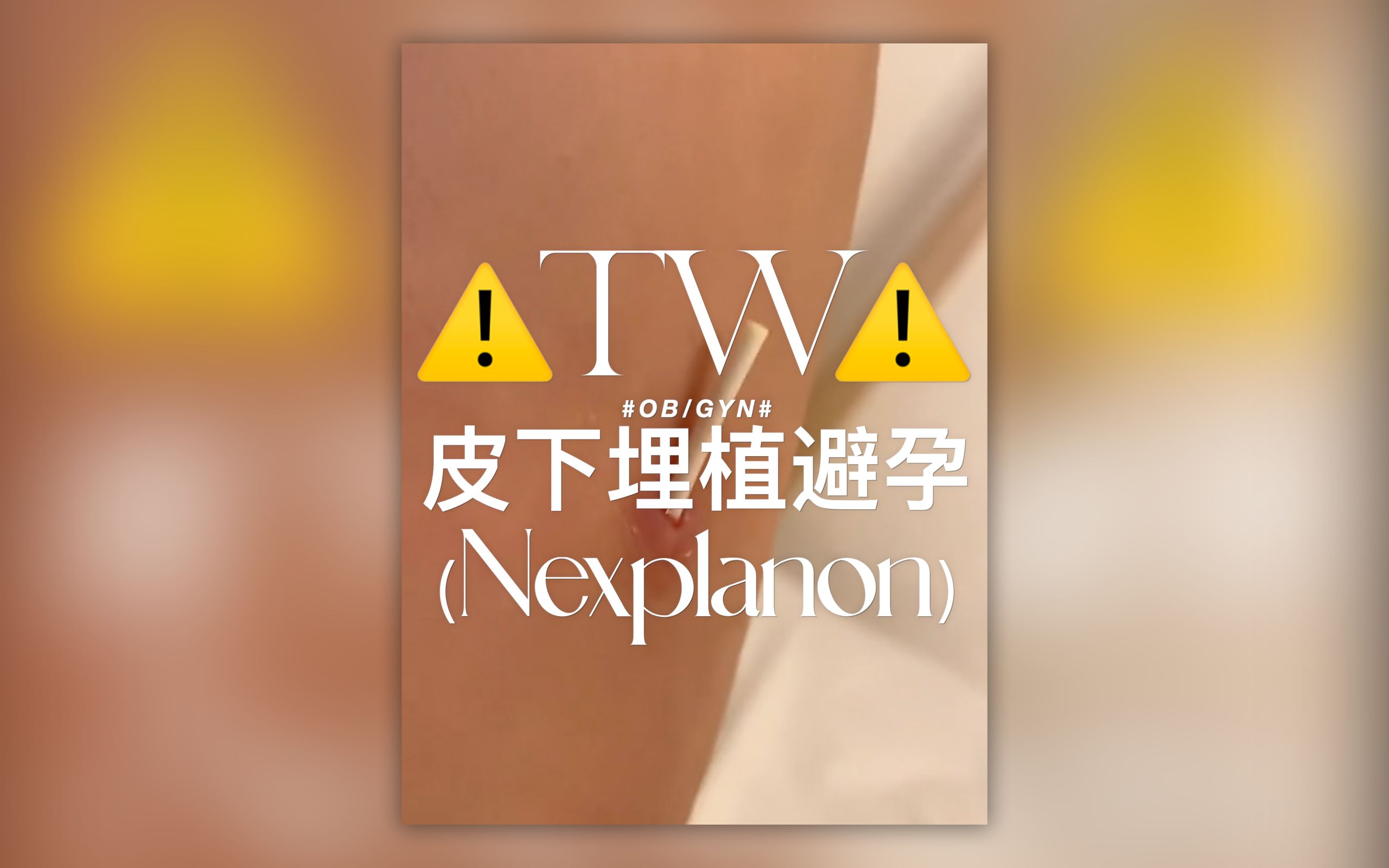 ⚠️ TW ⚠️ 皮下埋植避孕棒 (Nexplanon)从皮肤下面跑了出来哔哩哔哩bilibili