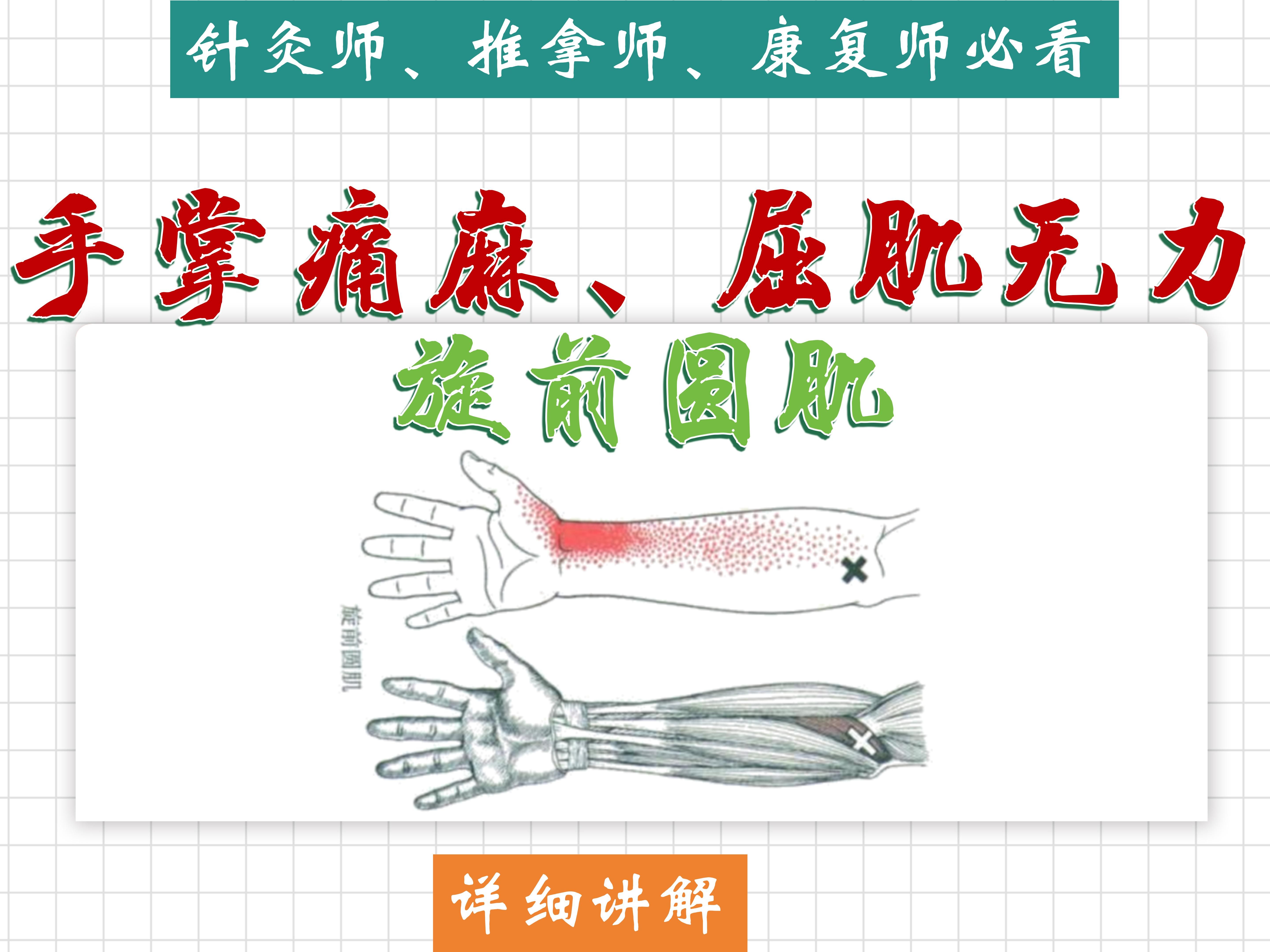 【手掌痛,屈肌無力】涉及肌肉(旋前圓肌)詳細講解——位置,功能,激痛