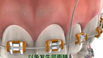 分享动画视频了解钢丝矫正，矫正期间千万不要吃较硬的食物哦