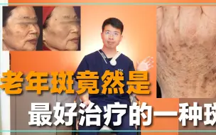 Download Video: 老年斑竟然是最好治疗的一种斑，听医生讲述治疗方法