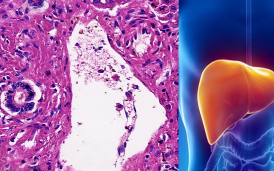 【小崔病理】25,肝脏的组织胚胎学(肝小叶和汇管区)哔哩哔哩bilibili