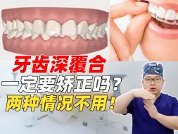 Download Video: 深覆合一定要矫正吗？这两种情况不用！