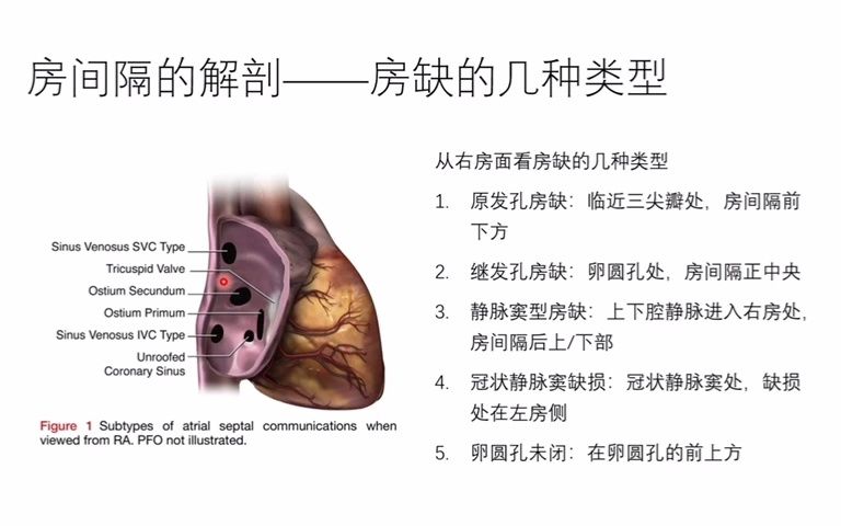 阜外TEE|房间隔缺损的TEE评估哔哩哔哩bilibili