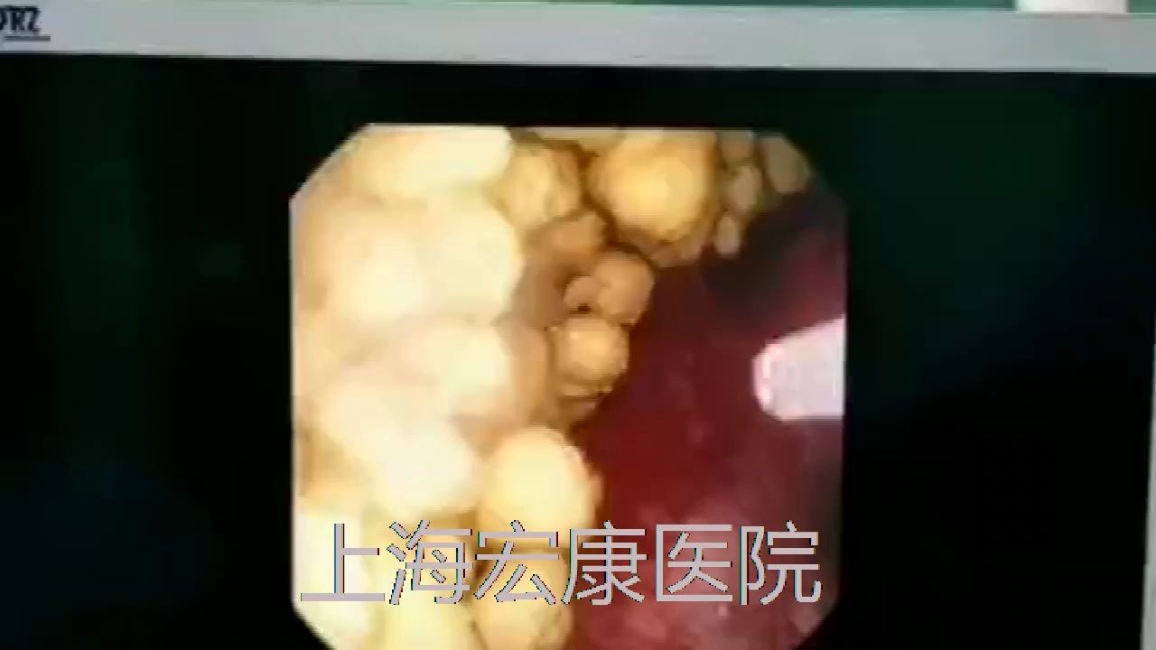 (上海宏康医院)取石篮捕抓结石视频哔哩哔哩bilibili