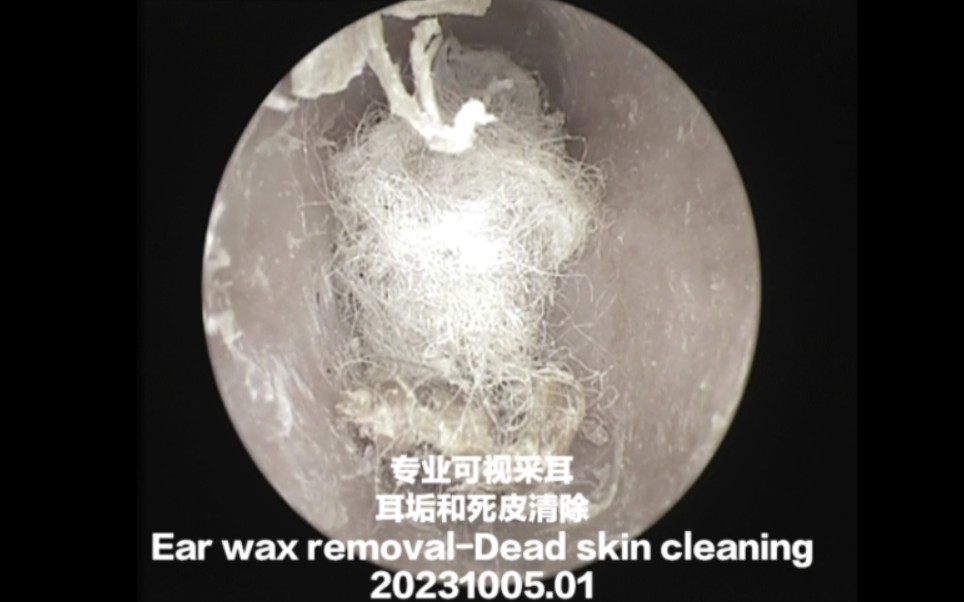 (去色版)专业可视采耳耳垢和死皮清除Ear wax removalDead skin cleaning 20231005.01哔哩哔哩bilibili