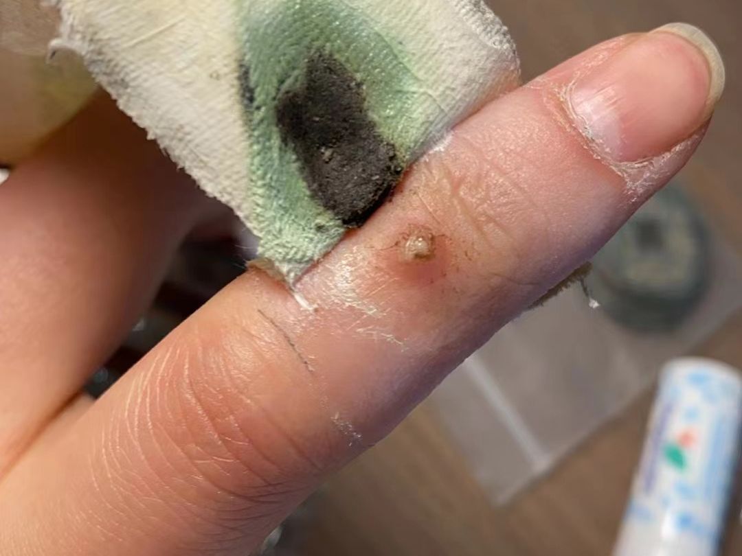 寻常疣,蜕变全过程