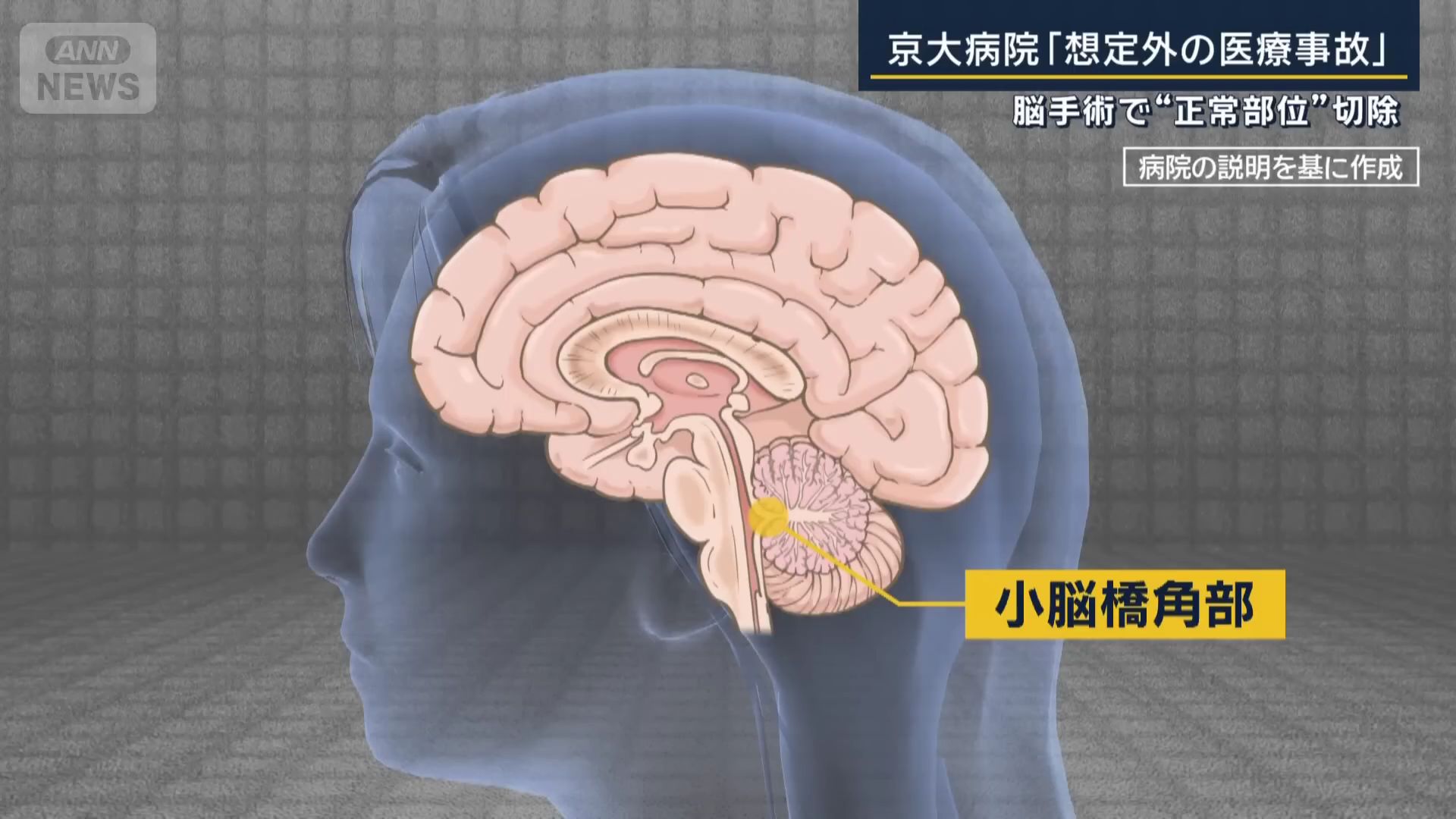 总之道歉就完事了?：切错脑子我们也感到很惊讶啊！日本京大医院医疗事故导致脑肿瘤患者变成植物人