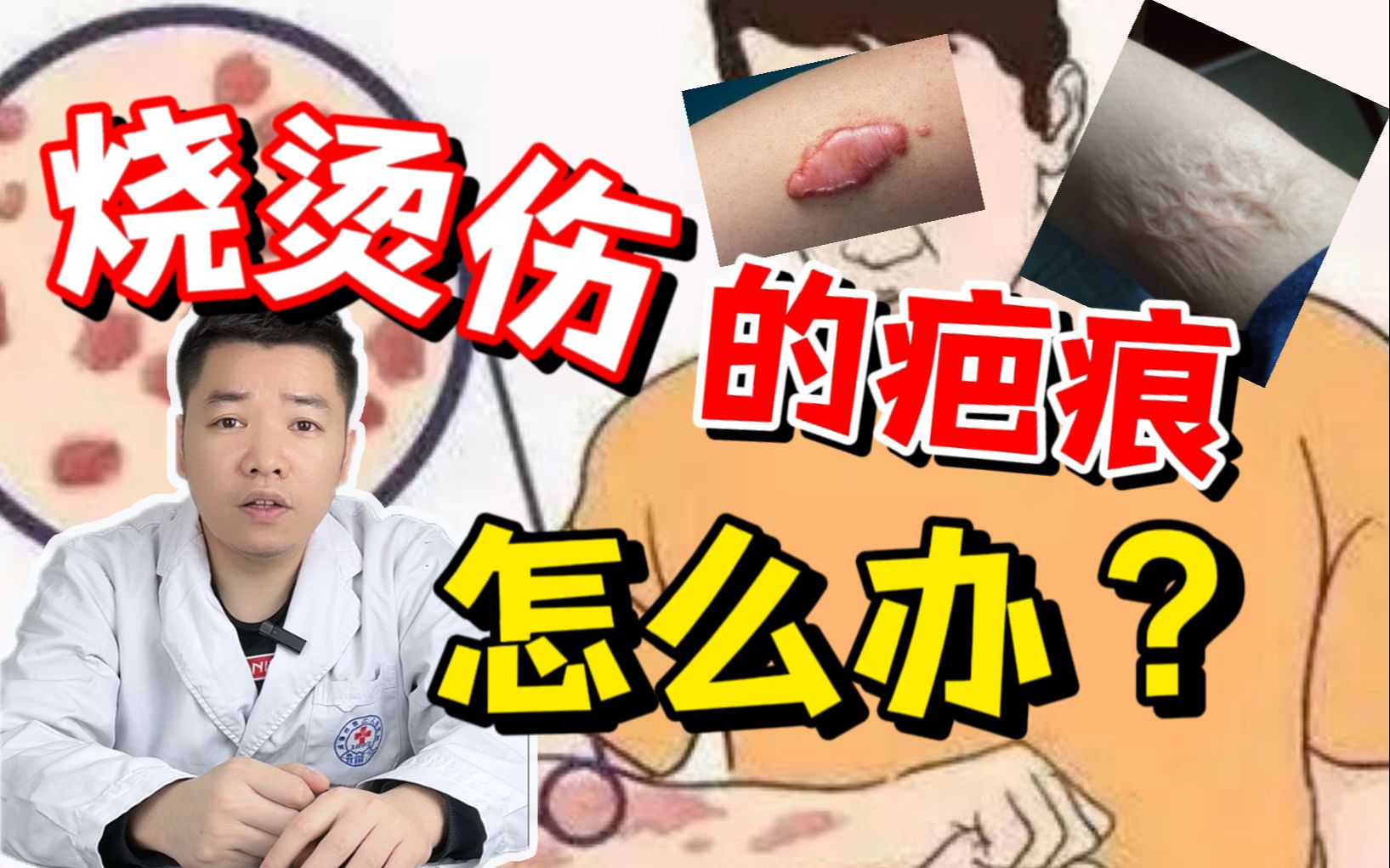 烧烫伤的疤痕怎么办?哔哩哔哩bilibili