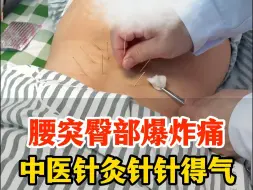 Download Video: 腰突臀部爆炸痛，中医针灸针针得气