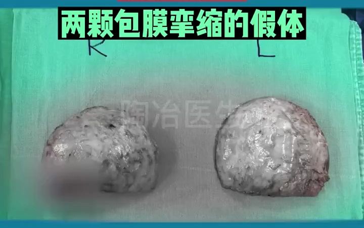 假体挛缩包膜像极了黑米馒头