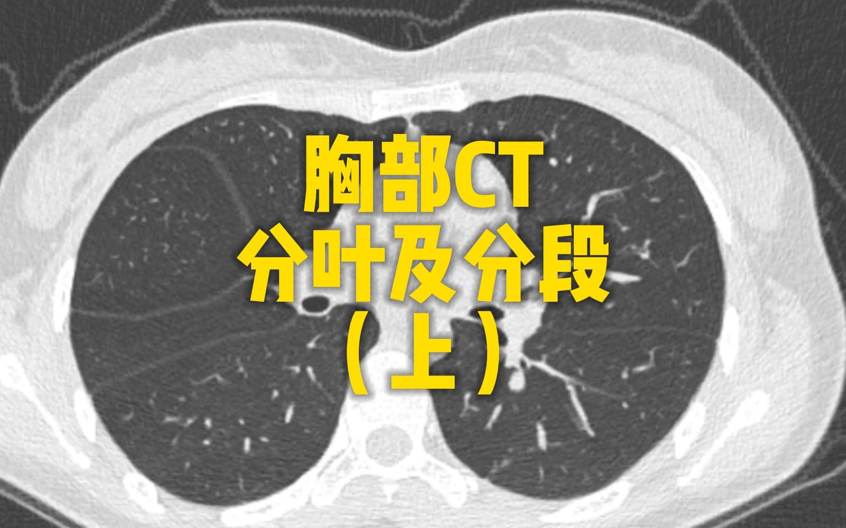 肺CT分叶分段(上)哔哩哔哩bilibili