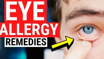 Eye Allergy Remedies - Tips for Itchy and Watery Eyes