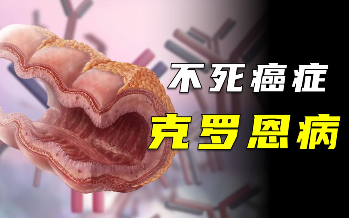 克罗恩病有什么症状(了解克罗恩病的常见症状)