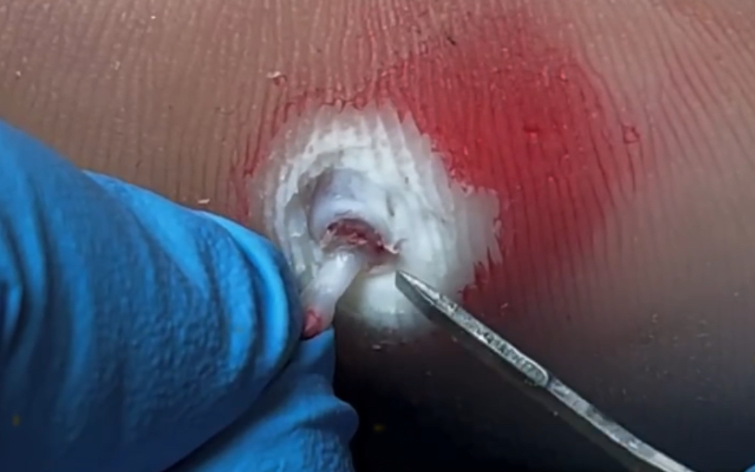 鸡眼儿连根拔起