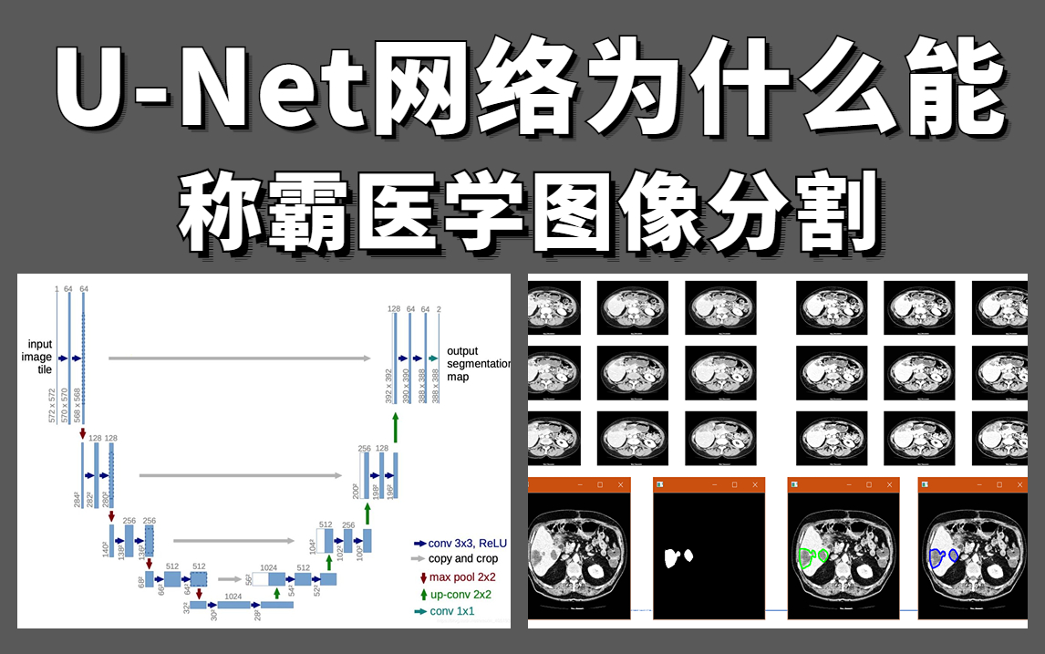 UNet网络为什么能称霸医学图像分割!基于UNet网络的医学图像分割实战,原理解读+项目实战,看完就能跑通!哔哩哔哩bilibili