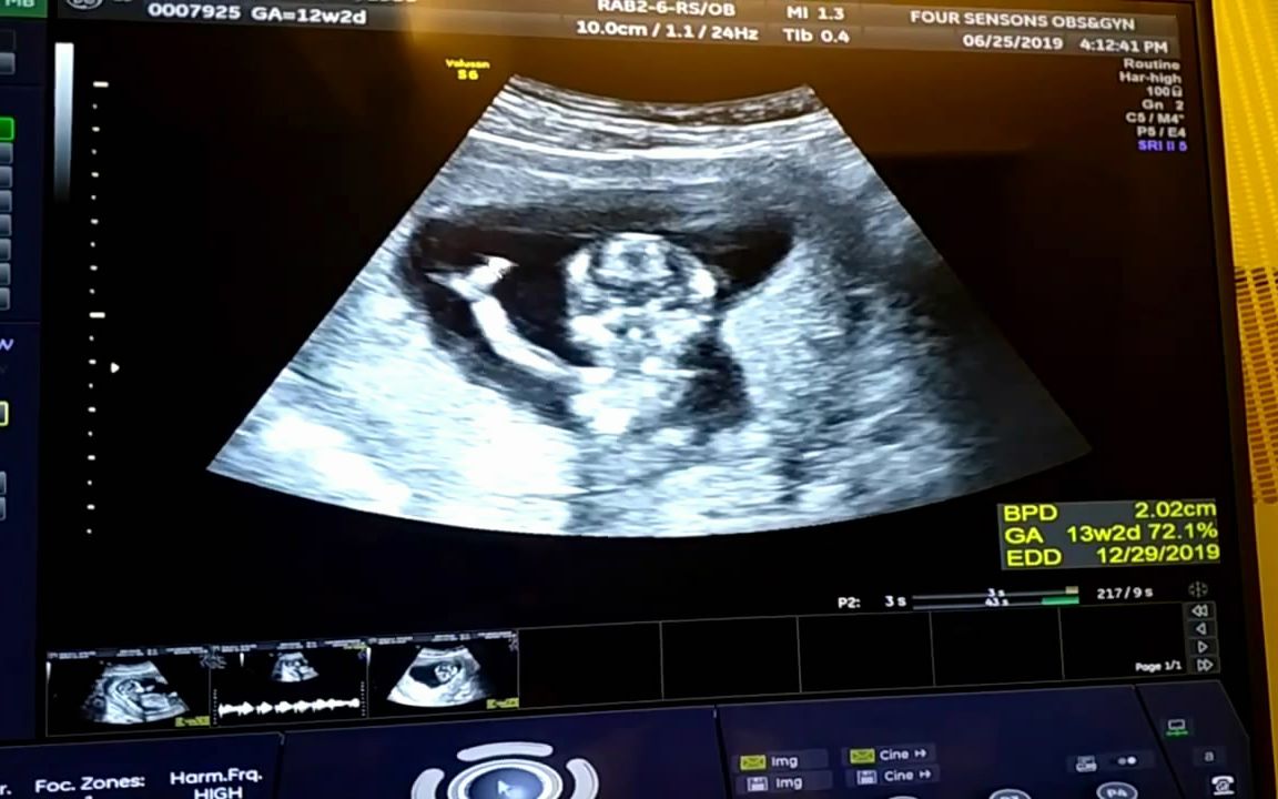 怀孕13周四维彩超产检实录,幸运的拍到了宝宝朝我们挥手致意!